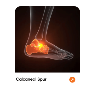 Calcaneal Spur