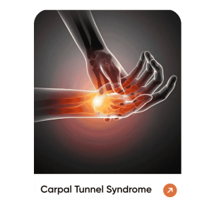 Carpal Tunnel Syndrome