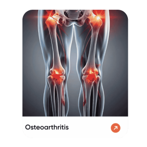 Osteo Arthritis (1)