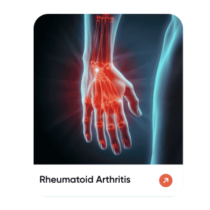 Rheumatoid Arthritis