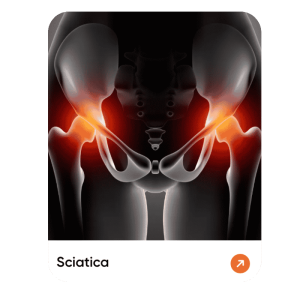 Sciatica