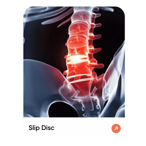 Slip Disc