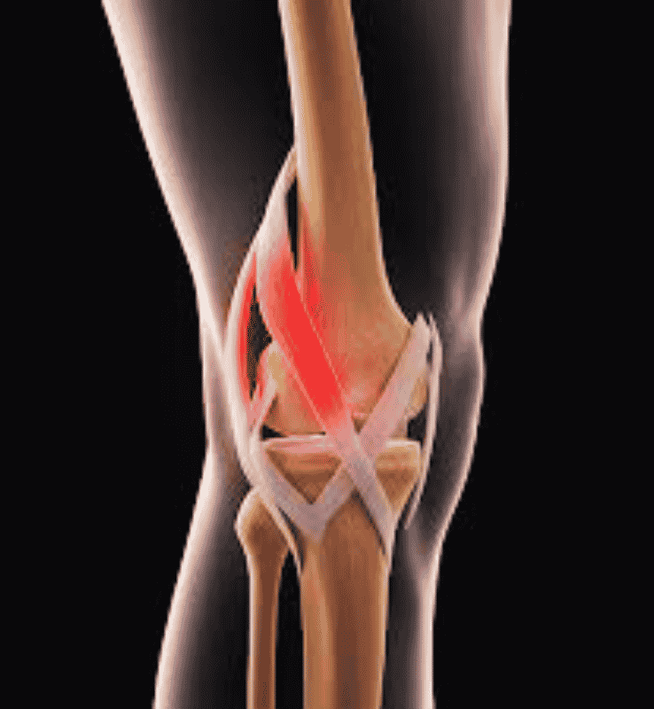 Tear of Anterior Cruciate Ligament