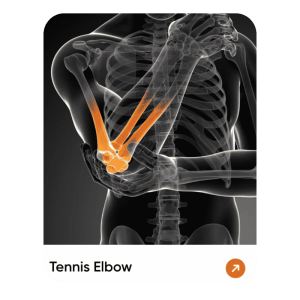 Tennis Elbow