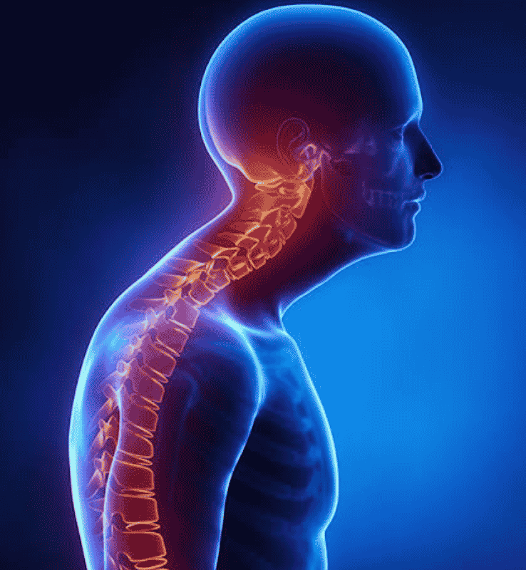 Cervical Spondylitis (1)