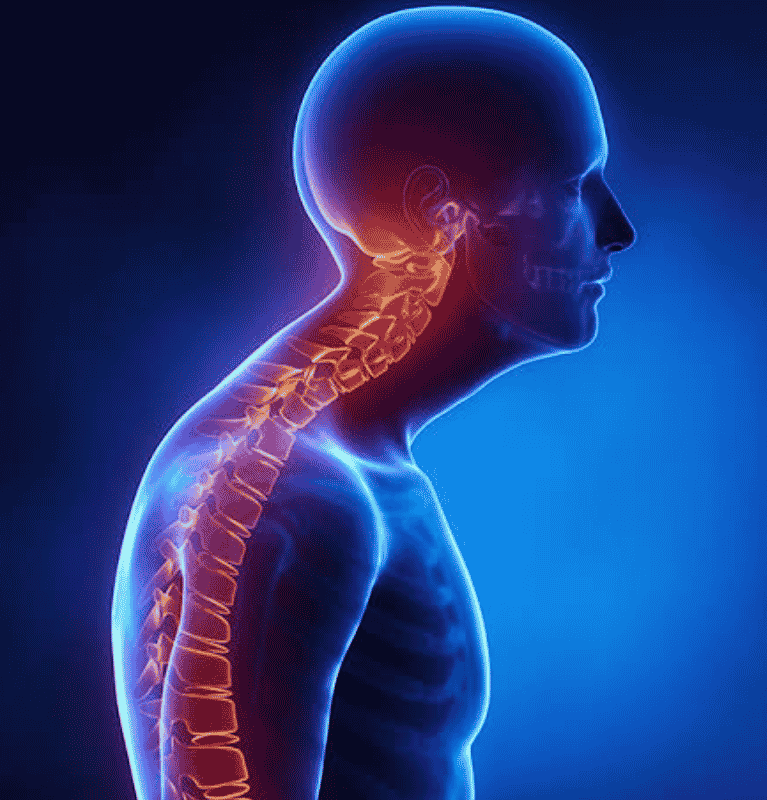 Cervical Spondylitis (1)