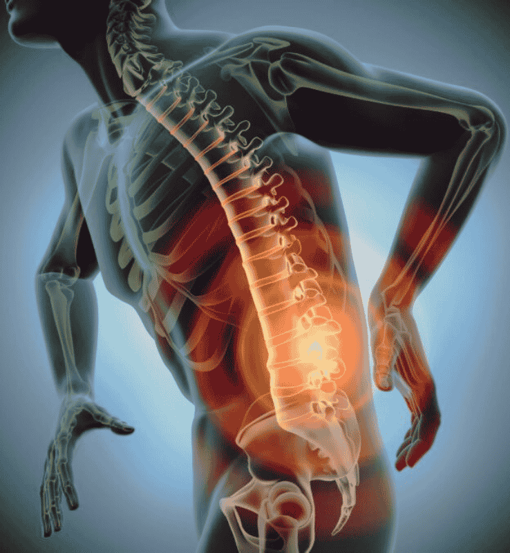 Lumbar Spondylitis with Sciatica