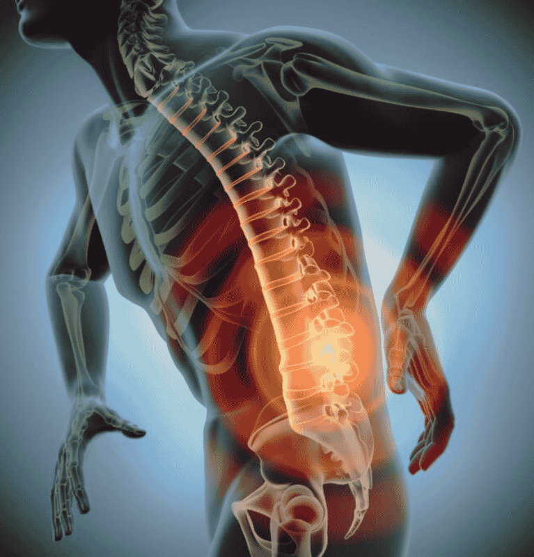 Lumbar Spondylitis with Sciatica