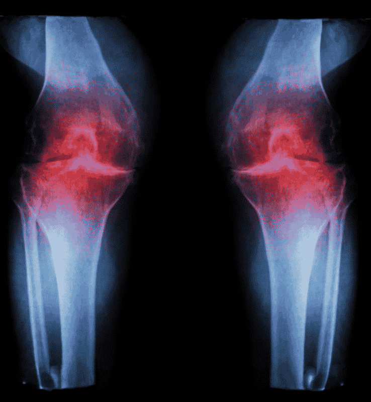 Osteo Arthritis of Both Knee Joints