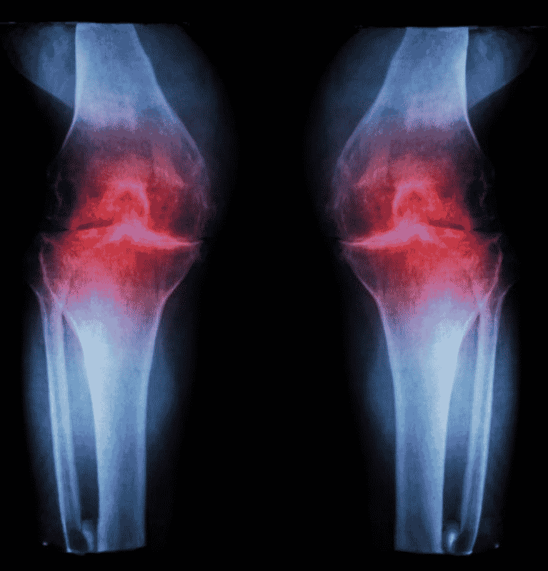 Osteo Arthritis of Both Knee Joints