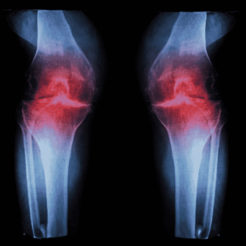 Osteo Arthritis of Both Knee Joints