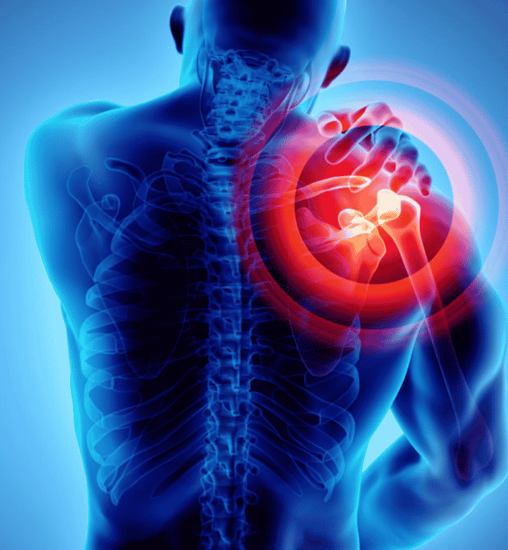 Osteo Arthritis of Right Shoulder Joint