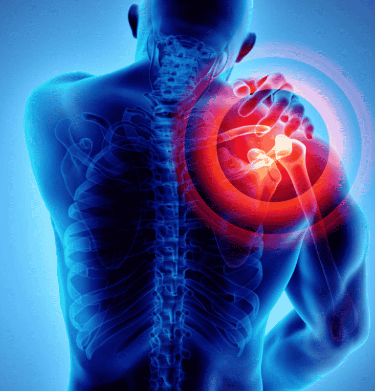 Osteo Arthritis of Right Shoulder Joint