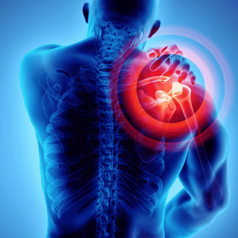 Osteo Arthritis of Right Shoulder Joint