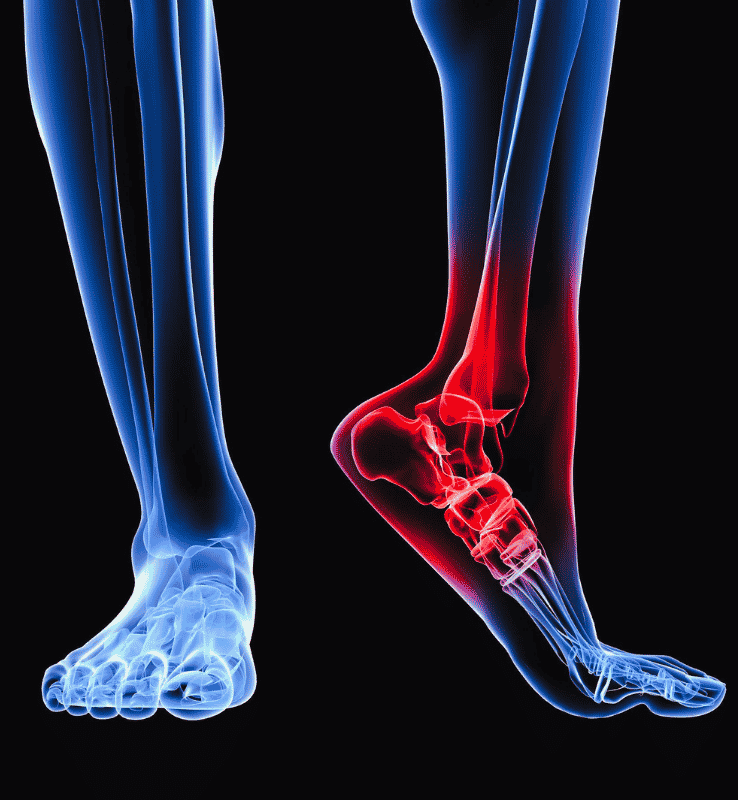 Plantar Fasciitis of Left Leg