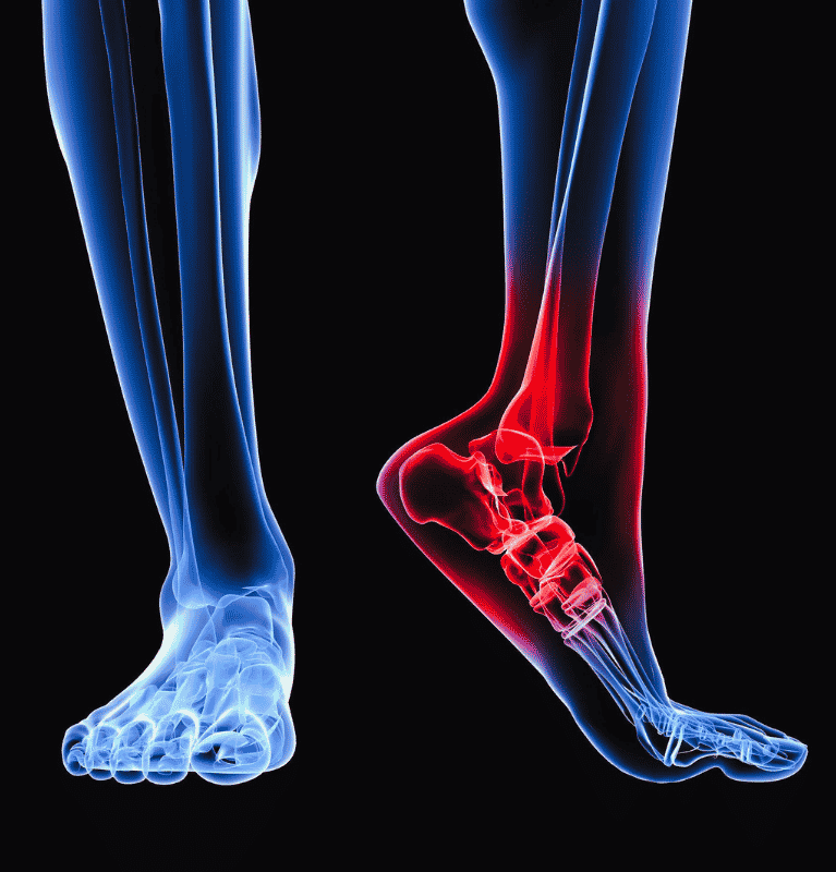 Plantar Fasciitis of Left Leg