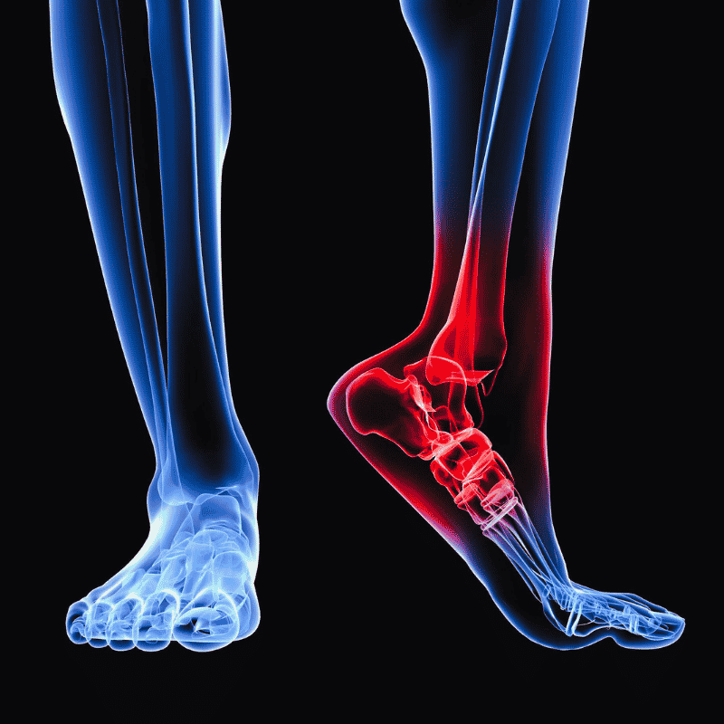 Plantar Fasciitis of Left Leg